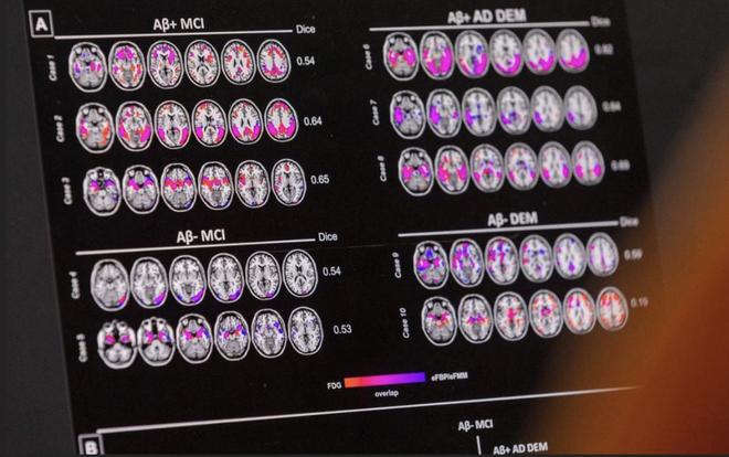 复旦大学重磅研究成果登上《自然衰老》：一滴血可提前15年预测痴呆症风险